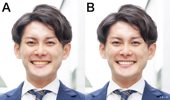 黄ばんだ歯の男性と白い歯の男性の比較
